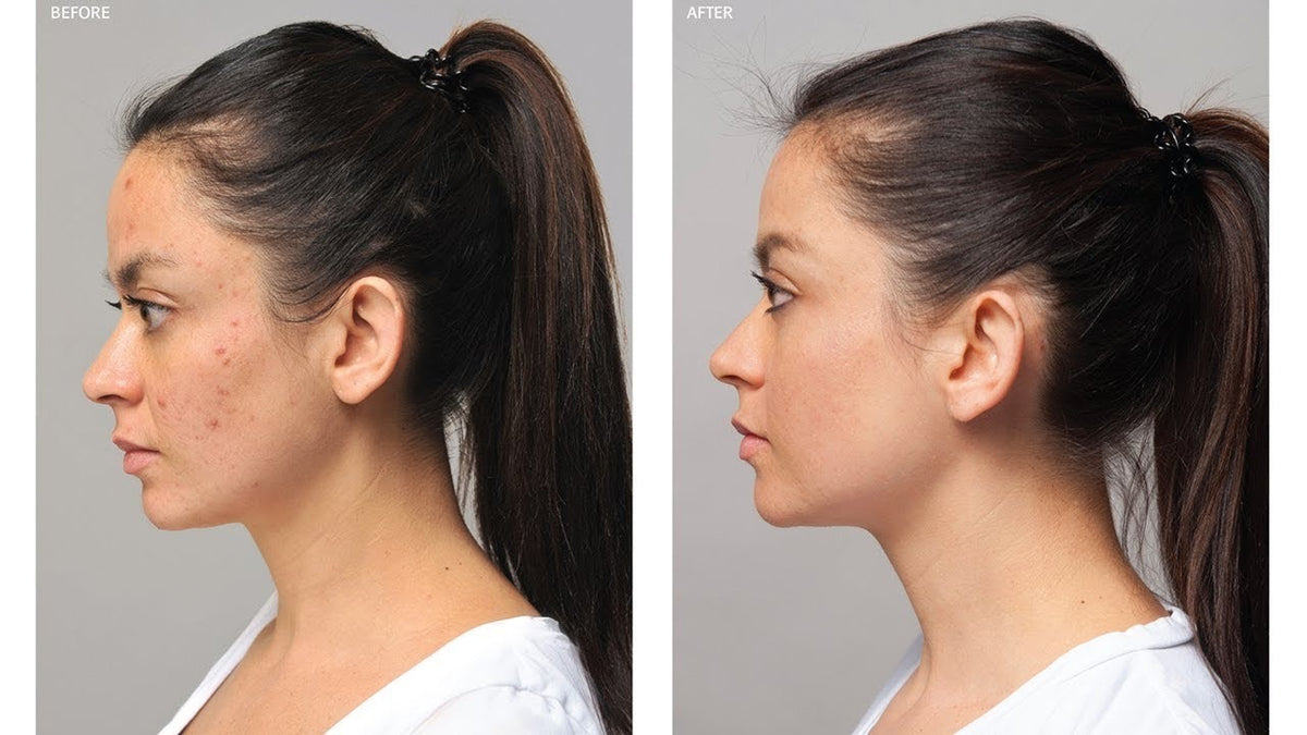 Eminence Organics Acne Advanced 3-Step Treatment System